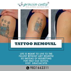 Best Tattoo Removal In Kolkata - Kolkata - free classified ads