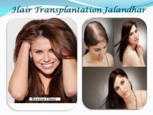 8 Hair transplant ideas  hair transplant transplant hair