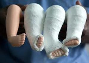 How To Get Best Treatment For Your Child Club Foot Problem Kolkata Free Classified Ads